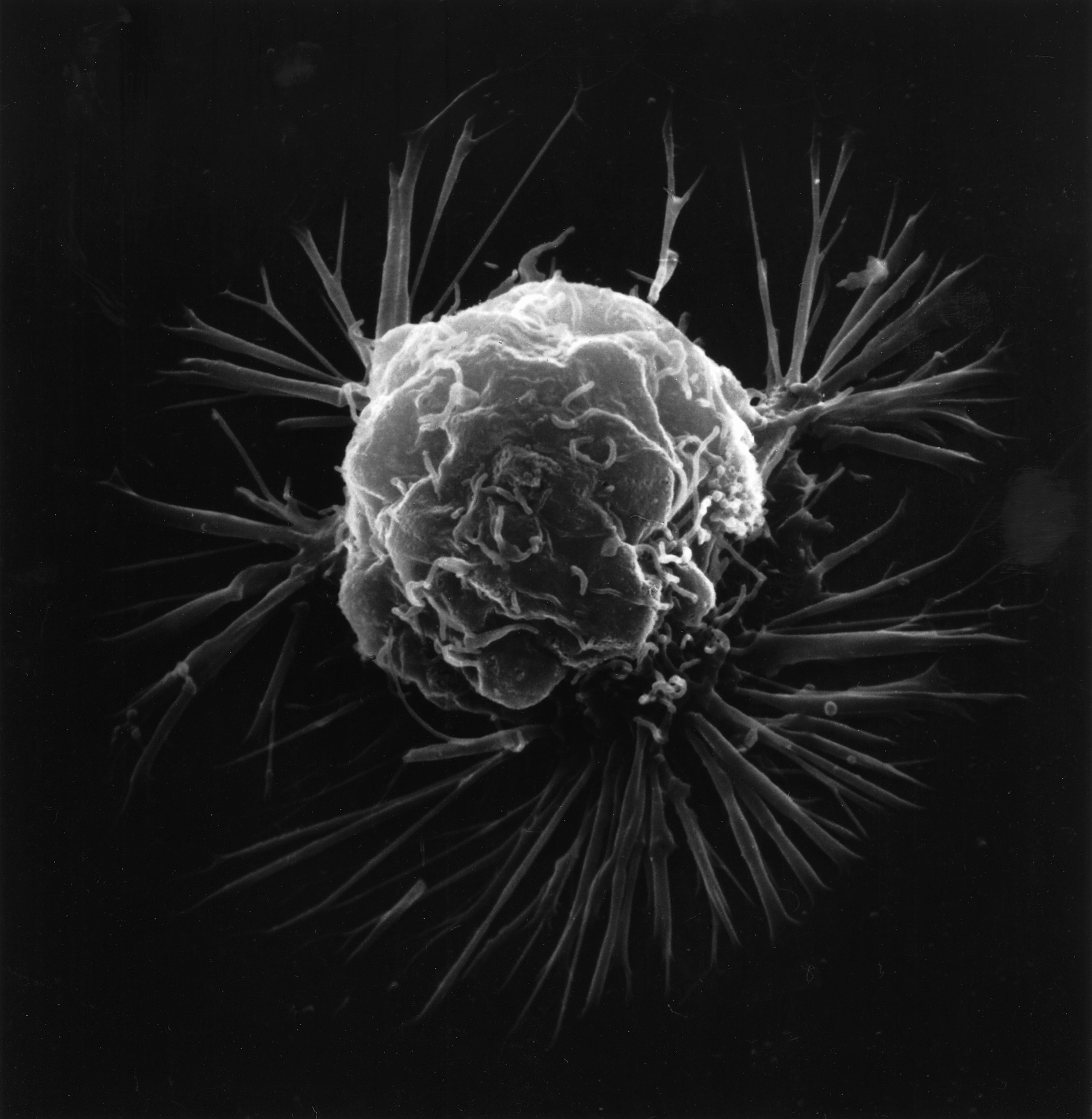 Imagem de referência de cancro, descrito nos dados abertos como grupo de doenças onde células anormais se multiplicam incontrolavelmente, destroem o tecido do corpo, prejudicam as funções normais e tem o potencial de se espalhar e invadir outros tecidos e Órgãos do corpo
