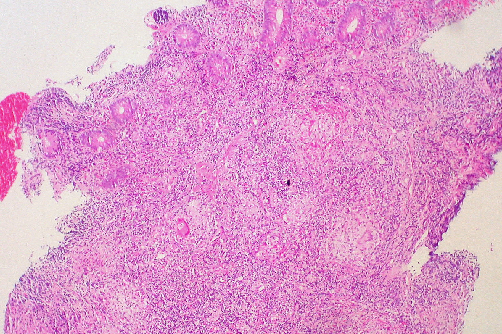 Imagem de referência de doença de Crohn, descrito nos dados abertos como tipo de doença inflamatória intestinal