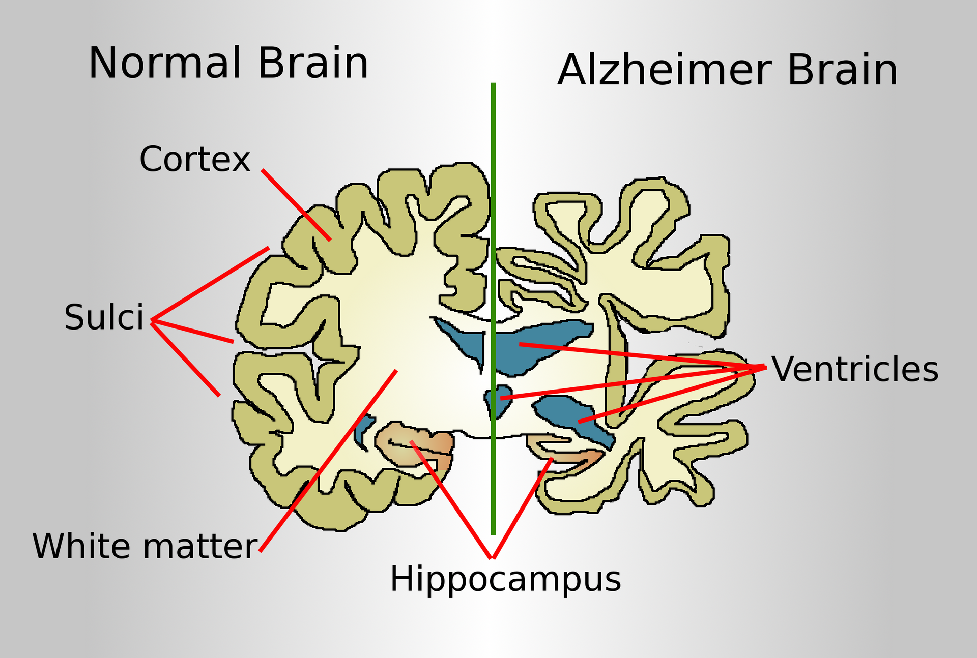 Imagem de referência de doença de Alzheimer, descrito nos dados abertos como doença neurodegenerativa progressiva caracterizada pela perda de memória