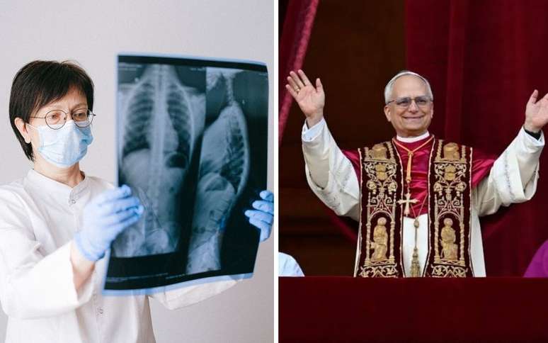 Nódulo pulmonar é sempre câncer? Entenda o caso do papa Leão XIV