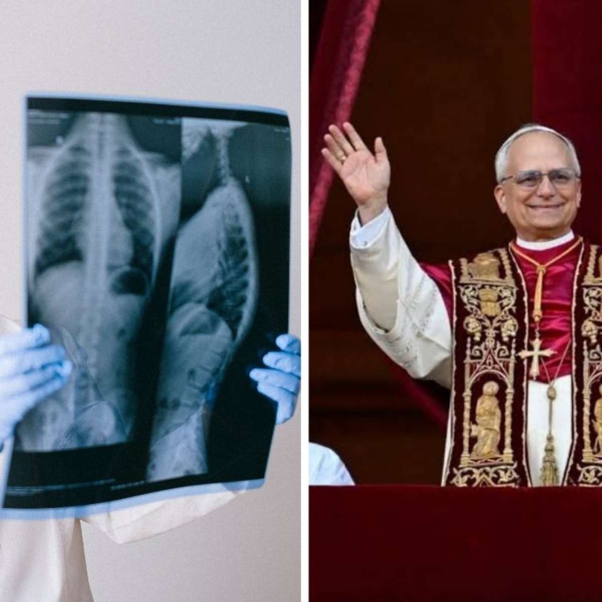 Nódulo pulmonar é sempre câncer? Entenda o caso do papa Leão XIV