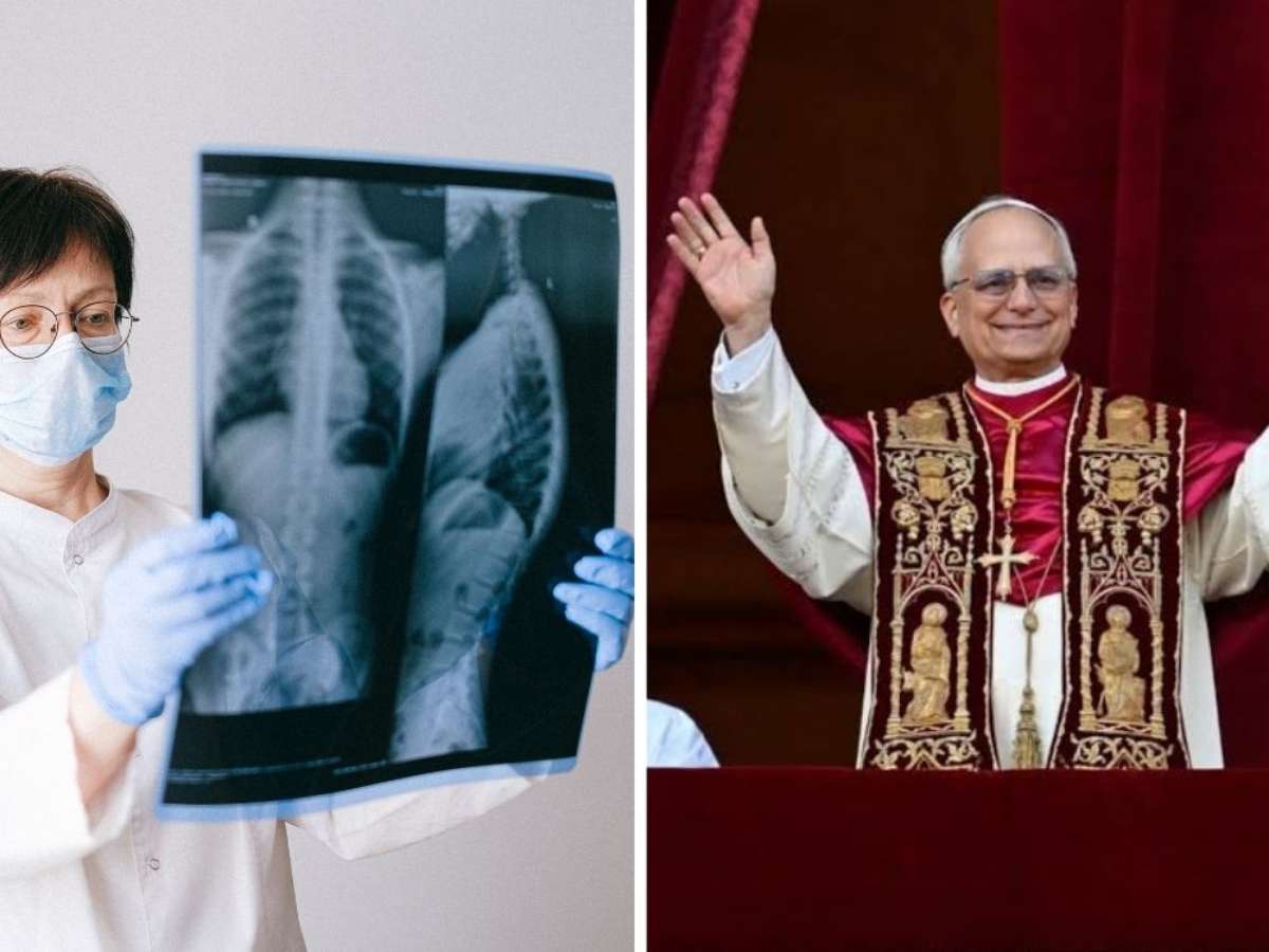 Nódulo pulmonar é sempre câncer? Entenda o caso do papa Leão XIV