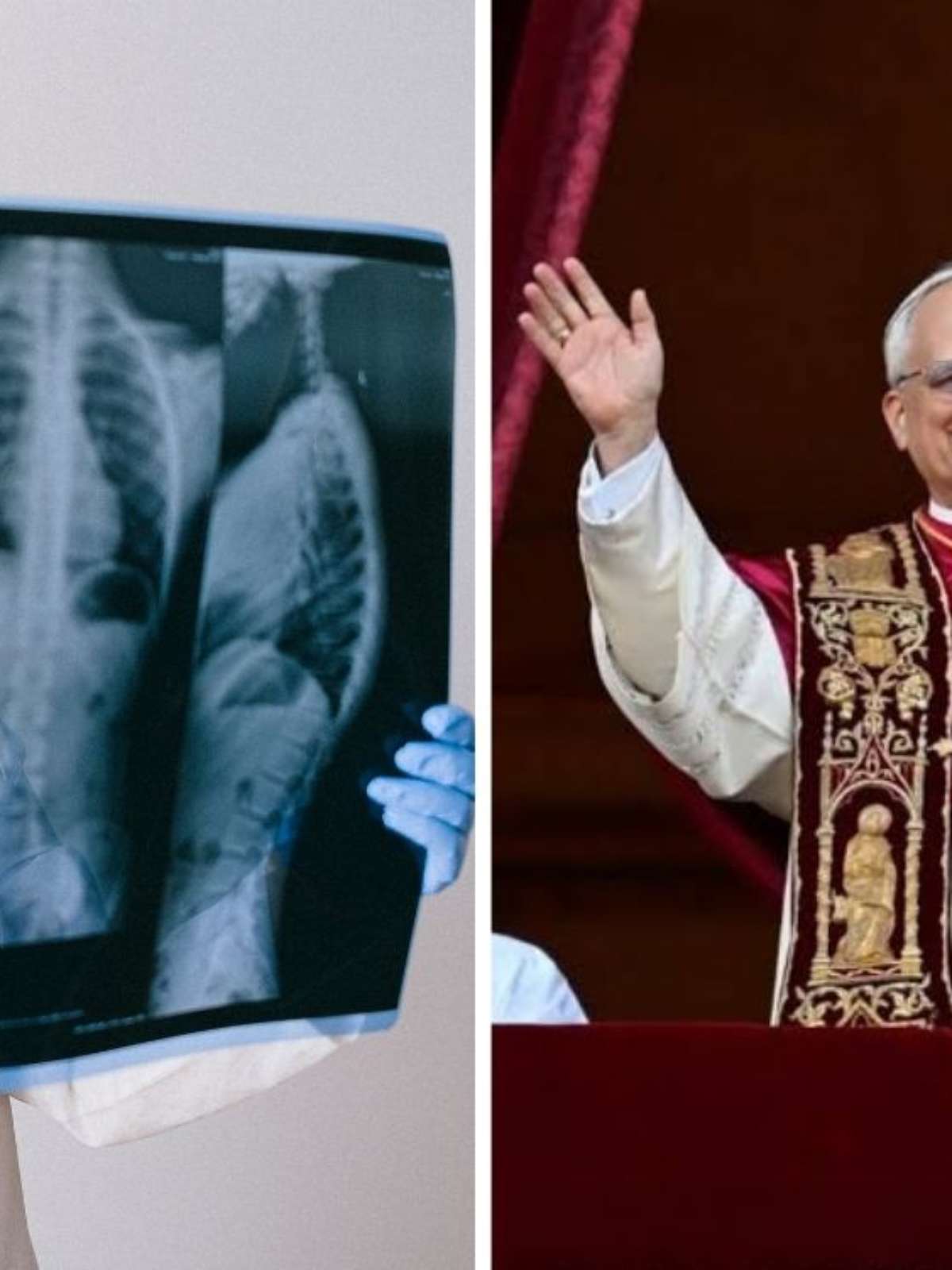 Nódulo pulmonar é sempre câncer? Entenda o caso do papa Leão XIV